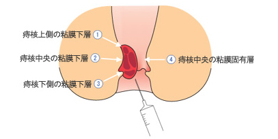 内痔核硬化療法剤