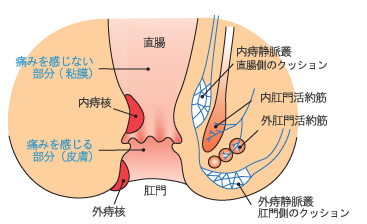 痔核